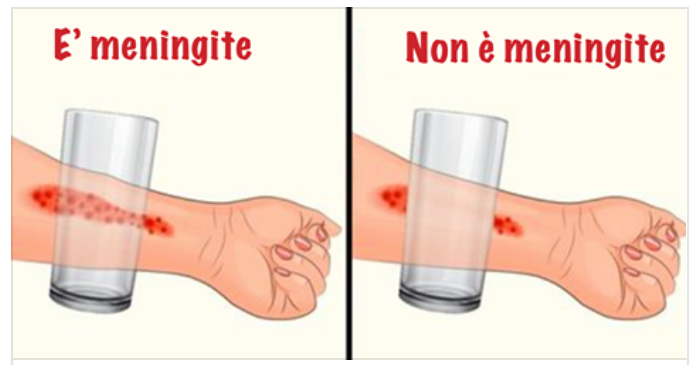 ECCO 8 SINTOMI DELLA MENINGITE CHE TUTTI DOVREBBERO CONOSCERE - 20/11/2017