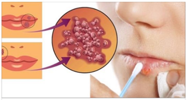 I 7 RIMEDI NATURALI PER CONTRASTARE L'HERPES LABIALE IN BREVISSIMO TEMPO - 16/10/2017