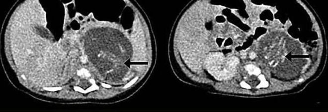 NEONATA NASCE INCINTA DI DUE GEMELLINI, LA MISTERIOSA MALFORMAZIONE SCONVOLGE I MEDICI - 27/03/2015