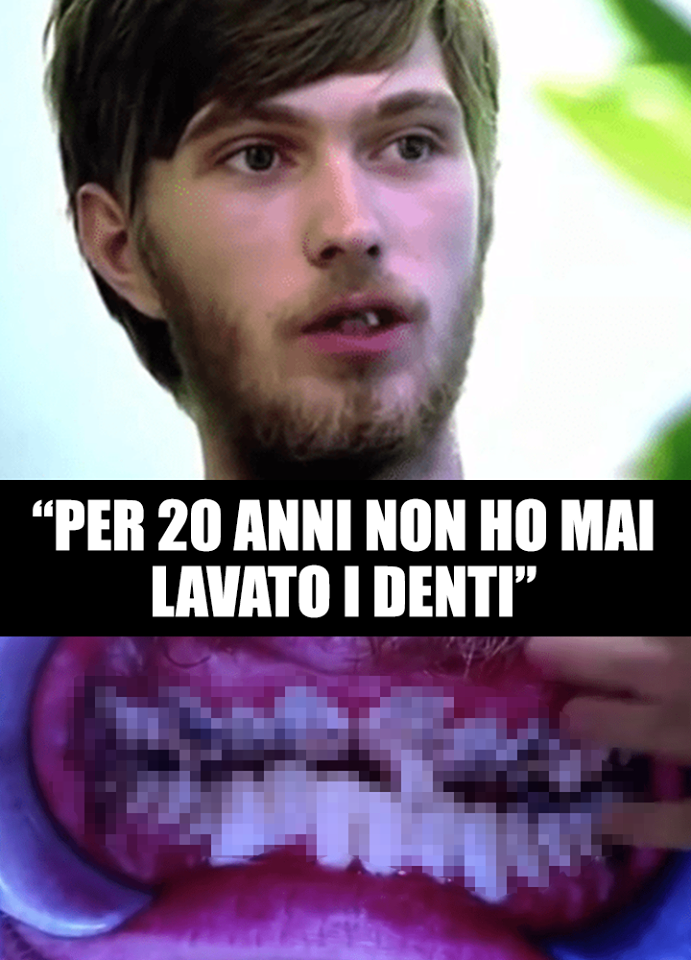 QUELLO CHE TROVA IL DENTISTA DENTRO LA SUA BOCCA E' DISGUSTOSO: ATTENZIONI IMMAGINI FORTI - 10/12/2017