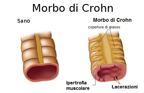 COS'E' IL MORBO DI CROHN? CIRCA 5 MILIONI DI PERSONE NE SONO AFFETTE - 22/10/2017