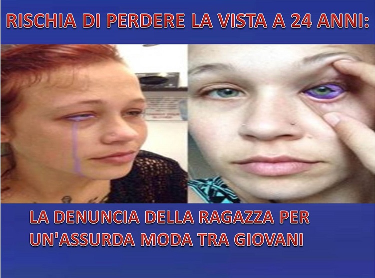 RISCHIA DI PERDERE LA VISTA A 24 ANNI: LA DENUNCIA DELLA RAGAZZA PER UN'ASSURDA MODA TRA GIOVANI - 03/11/2017